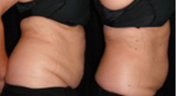 Primary Aesthetics in Bedford is adding celebrity “fav” Body Slimming  Experts (BSE) Ultra-Slim Plus II - Stacyknows