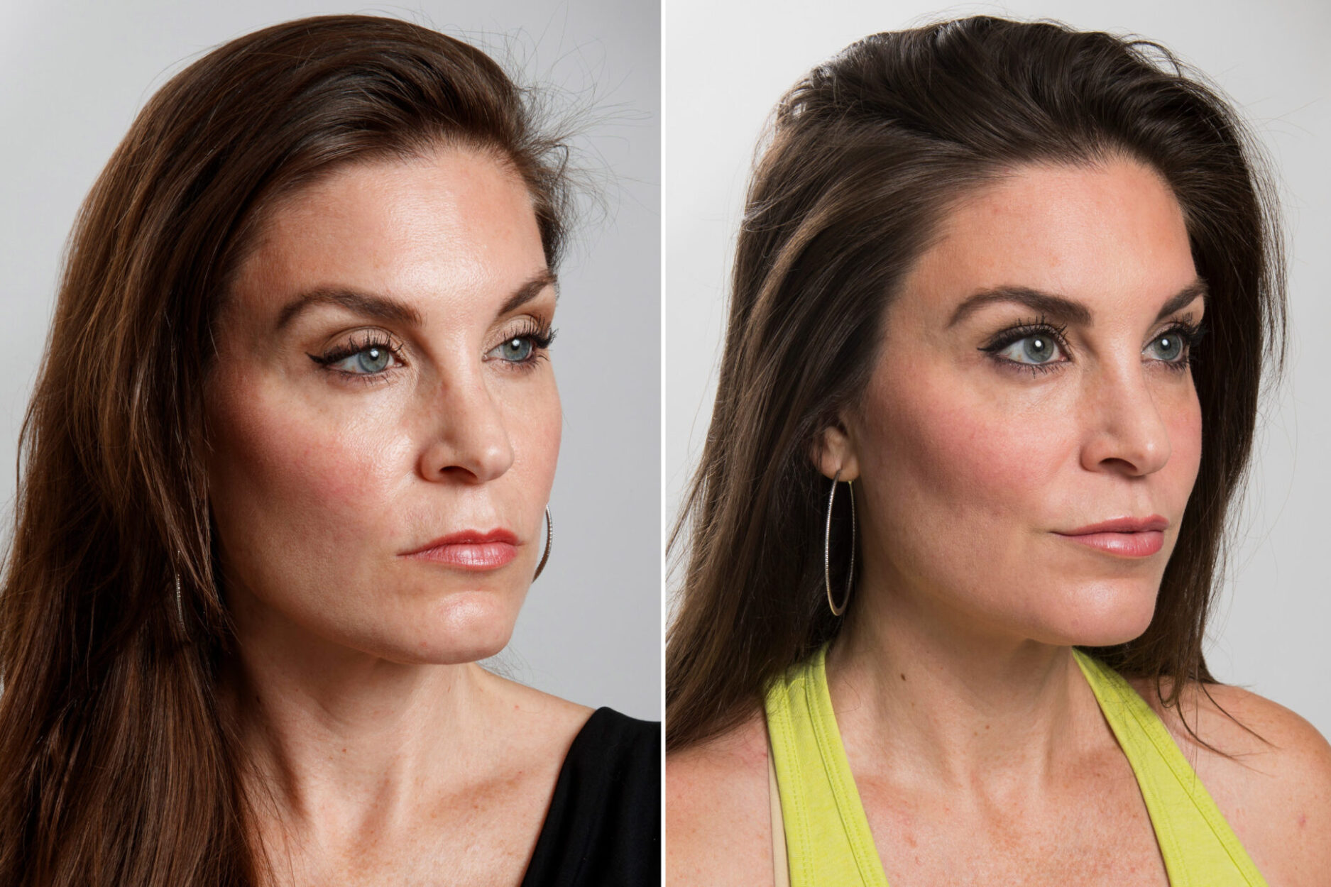 Getting Rid Of ‘Resting B- Face’: Cosmetic Surgeons Say ‘happiness Look ...