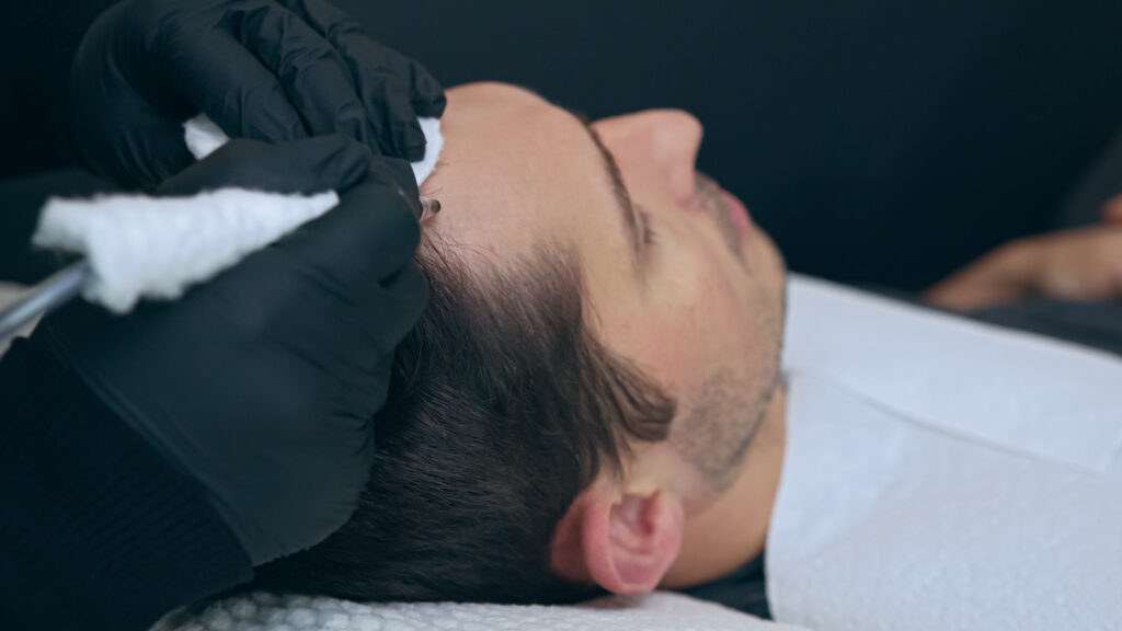 7 Things To Do Before Your Scalp Micropigmentation Treatment – Stacyknows
